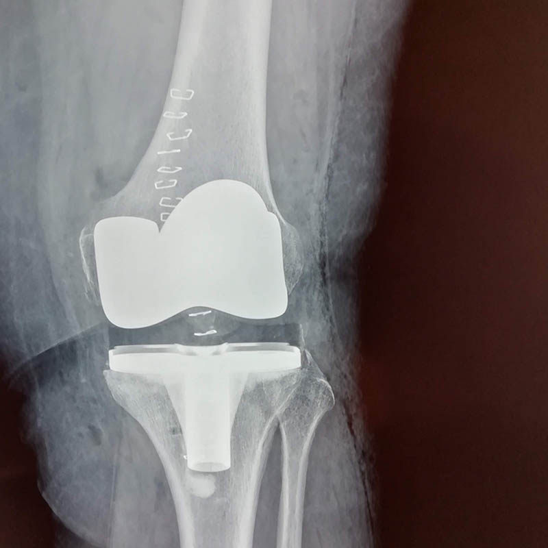 Ακτινογραφία της τεχνητής άρθρωσης στην oλική αρθροπλαστική γόνατος
