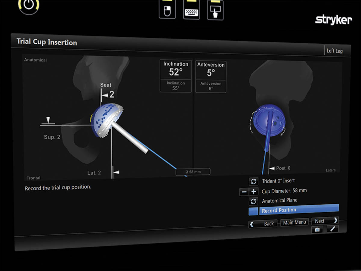 Στιγμιότυπο χρήσης του OrthoMap Precision Knee