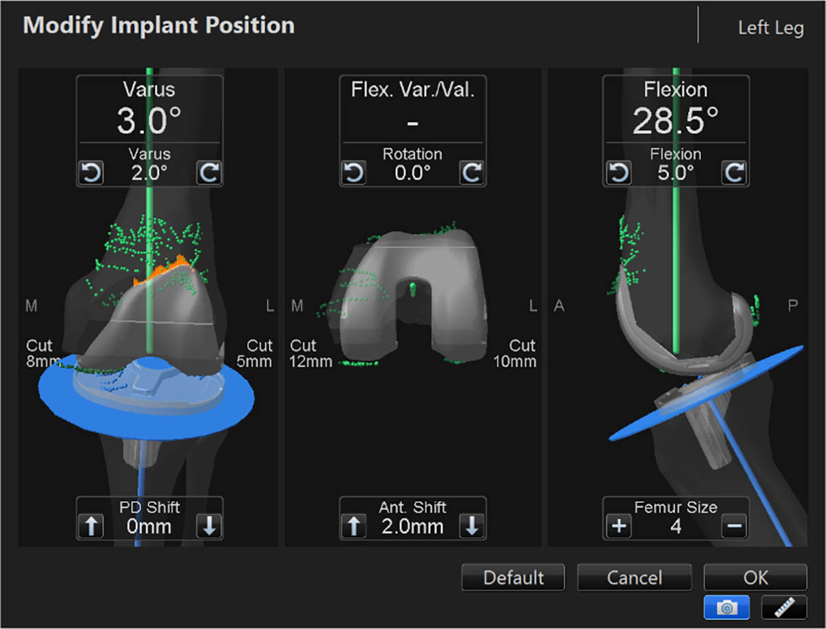 Στιγμιότυπο χρήσης του OrthoMap Precision Knee