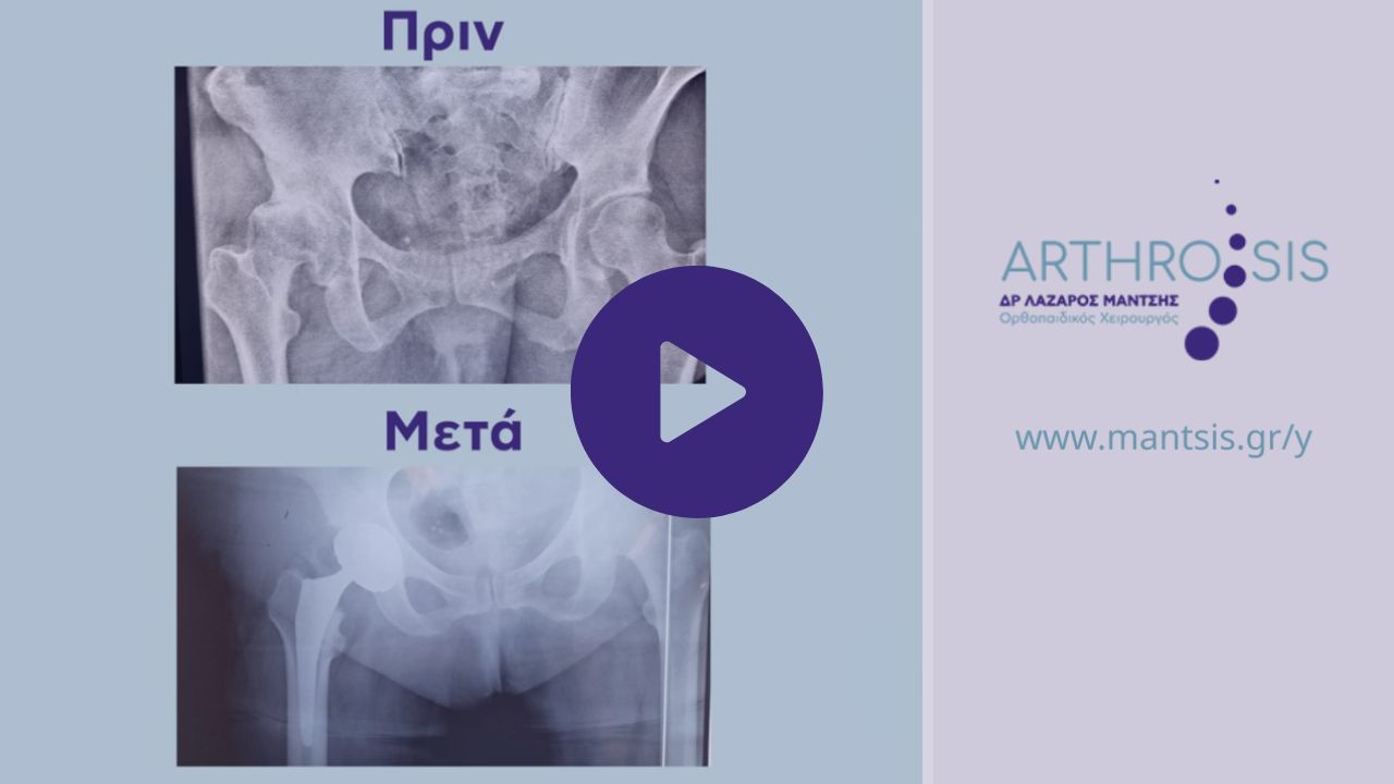 Thumbnail για το YouTube video Ολική Αρθροπλαστική Ισχίου σε ασθενή με υψηλό BMI